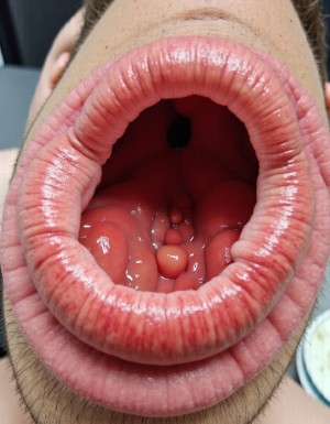 un ano se muestra abierto con su interior de color rojo, en el fondo se aprecia un líquido blanco y espeso