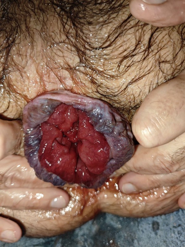 Xtudr - ojete reventado por fisting Avanzando con mi coño pero ahora estancado. Quiero que crezca y se salga solo.Algun macho me ayuda?