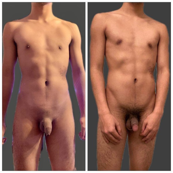 Xtudr - Acucullofilia La diferencia entre el mismo hombre tras la circuncisión es evidente, en este caso una circuncisión sin razones médicas, solo por razones personales es decir una cirugía estética para mejorar la apariencia del pene.