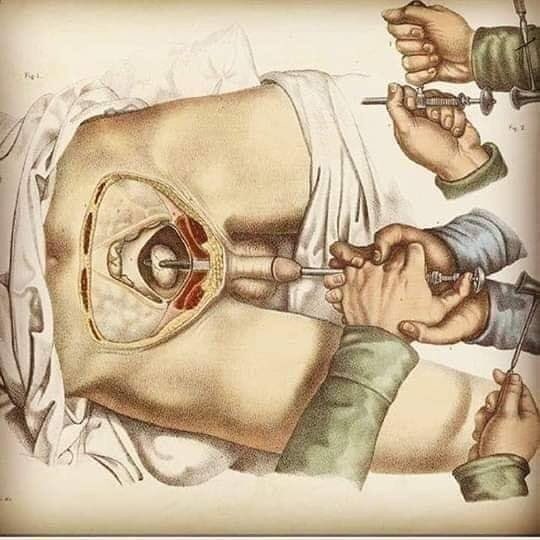 Xtudr - CULTURISEX MEDICINA: LITOTOMIA

Hasta 1846 se realizo sin anestesia la LITOTOMIA que consiste en romper en los hombres  piedras o cálculos de la vejiga, pasando  un clavo a través del pene y con un martillo la rompían en  trocitos  pequeños para que pasaran a través de su uretra. La Litotomia para eliminar cálculos se realizó sin anestesia hasta 1846.


https://youtu.be/Ncnm-Ihn--U?si=7e4oQR0yOaokHT3x
Litotomía y su evolución. Medicina Insólita: increíble, pero real.

-----

Transurethral rigid ureteroscopy

https://youtu.be/0OyrZhluzm4?si=QU24C6oZI99-oztD
