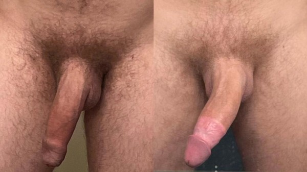 Xtudr - Acucullofilia https://youtu.be/3CHWH8w0n_I?si=xX0Xjixwss7pVhQk

HISTORIAS DE LA MILI Y LA FIMOSIS EN LA TARDE AQUI Y AHORA

La operación de fimosis normalmente es una circuncisiión completa, que deja totalmente el glande al descubierto, es la circuncisión total