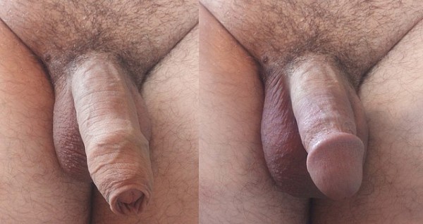 Xtudr - Acucullofilia Tras una circuncision total el glande queda permanentemente al descubierto.