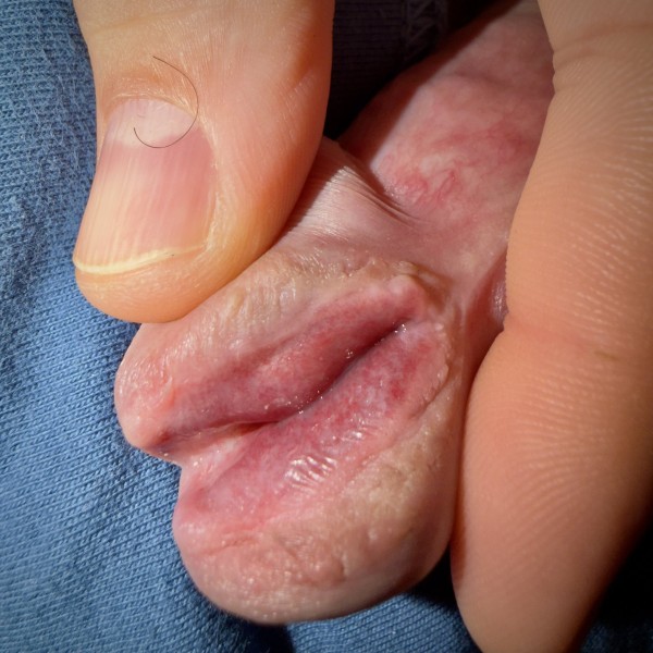 Xtudr - Subincisión Un ejemplo de meatotomia