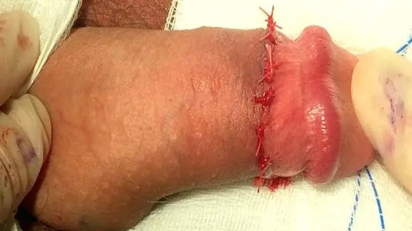 Xtudr - Acucullofilia https://www.urologocarrillo.com/circuncision/circuncision-fotos
